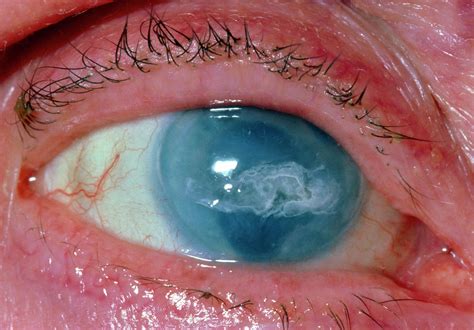 calcified eye of erudition  On physical examination, senile scleral plaques appear as flat, well-circumscribed, ovoid scleral patches located lateral or medial to the limbus